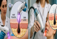 Laser Hair Removal: Popular Beauty Treatment, But Know These Possible Side Effects First Laser hair removal cosmetic treatment targeting hair follicles on skin